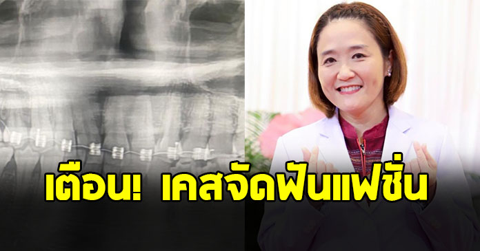 ทันตแพทย์ เตือนเคส ผู้ป่วยจัดฟันแฟชั่น วัย 20 ปี ต้องใช้ลิ้นหัวใจเทียมตลอดชีวิต
